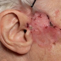 basal cell carcinoma on skin