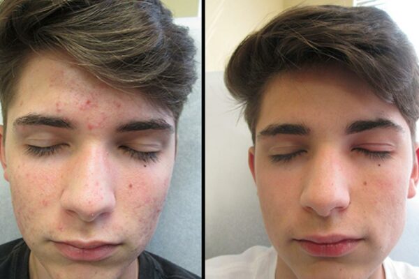 acne-before-after