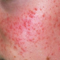 Adult Acne Treatment - Red Pimple Blemishes that can be treated with medical intervention from an acne dermatologist in London.