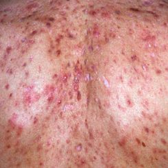 Adult Acne Scars that Require Treatment by a Acne Dermatologist Clinic