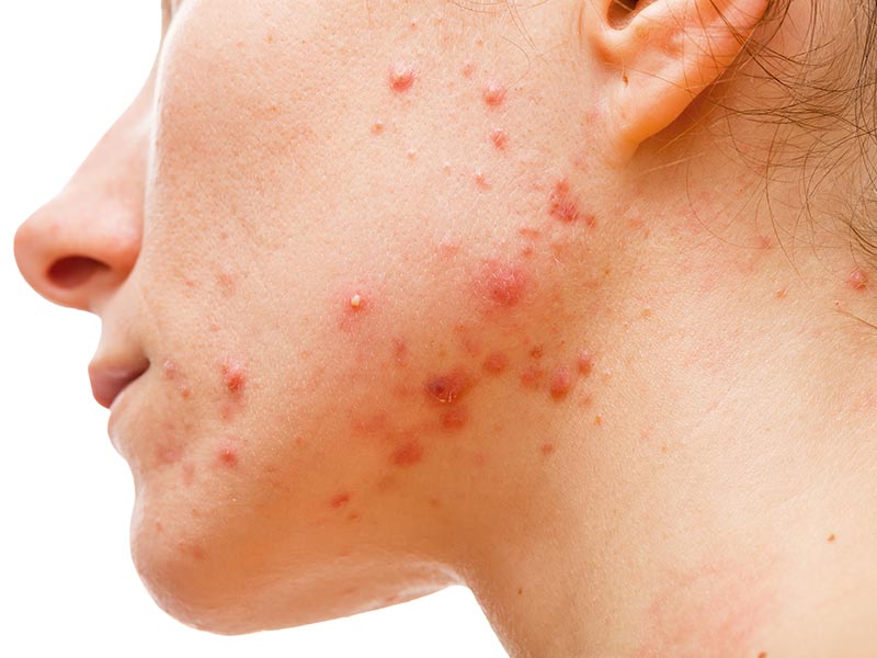 Large fungal acne on skin | Acne treatments | Harley Street Dermatology Clinic