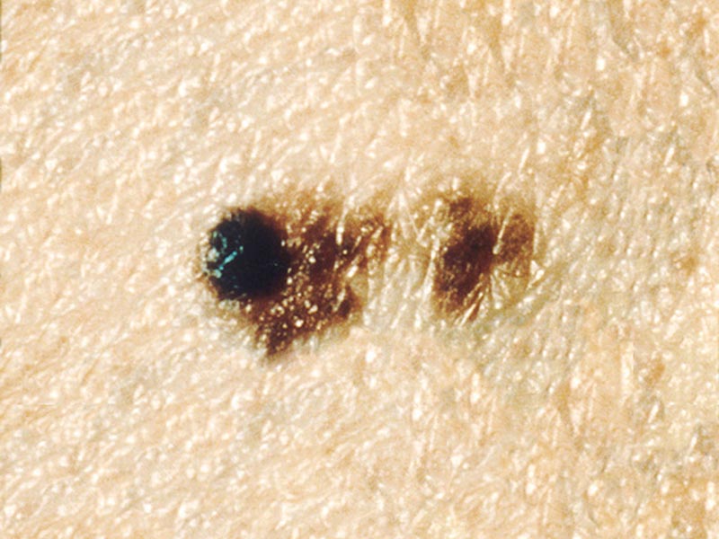 melanoma on skin