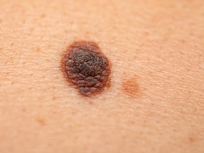 melanoma on skin