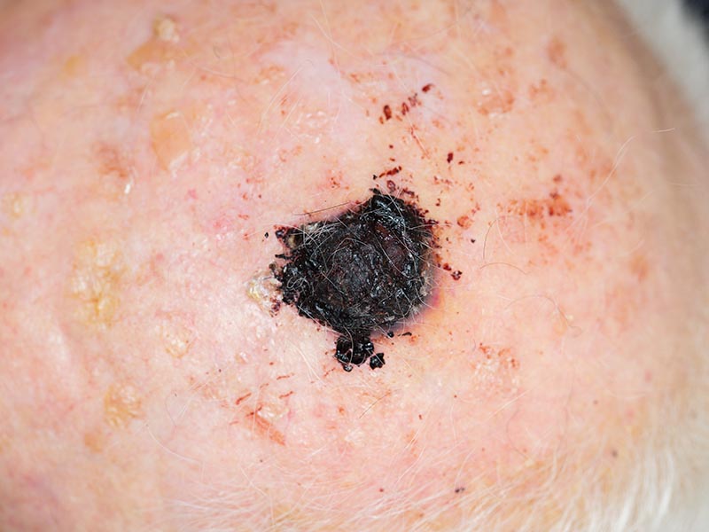 large malignant melanoma