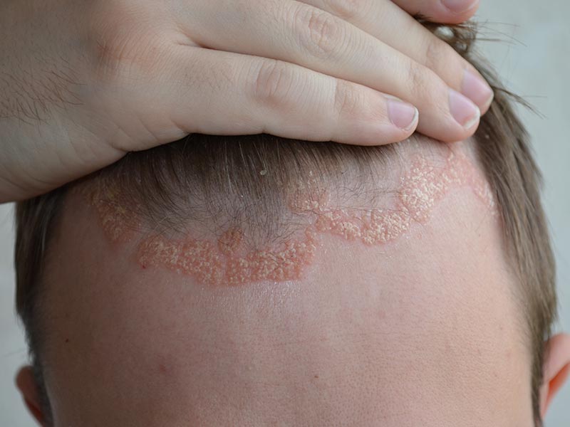 psoriasis on hairline