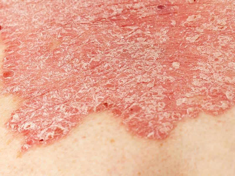 large area of psoriasis