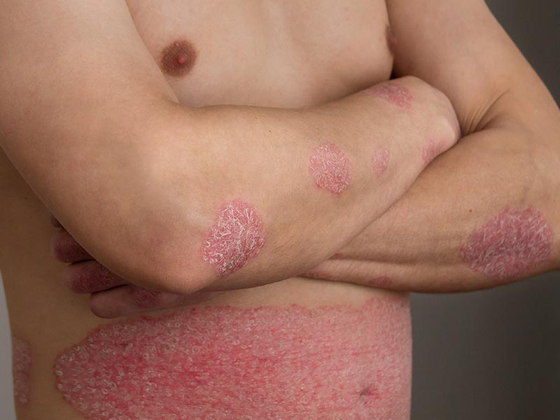 psoriasis patches