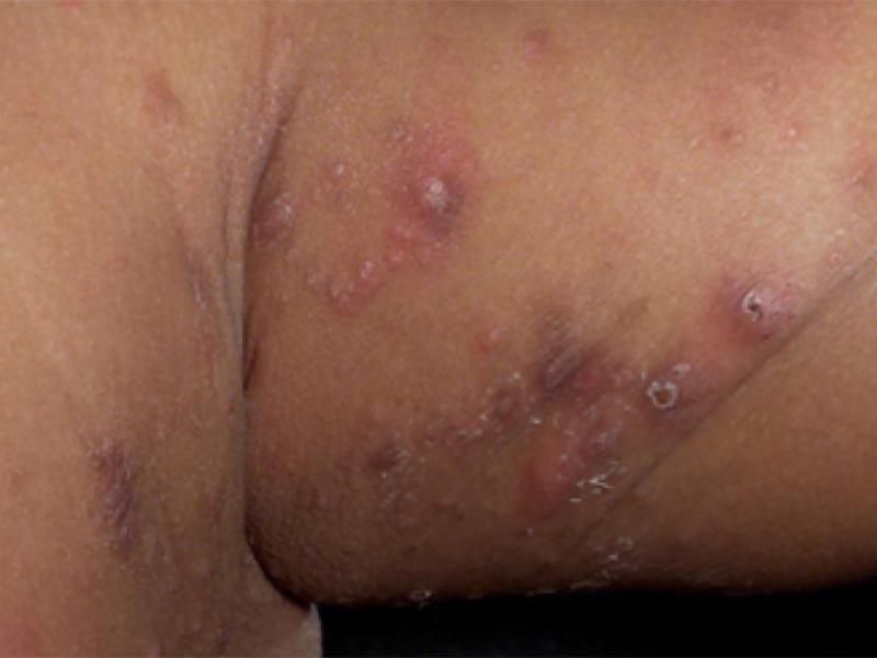 scabies on skin