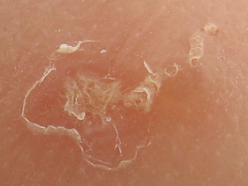 scabies example