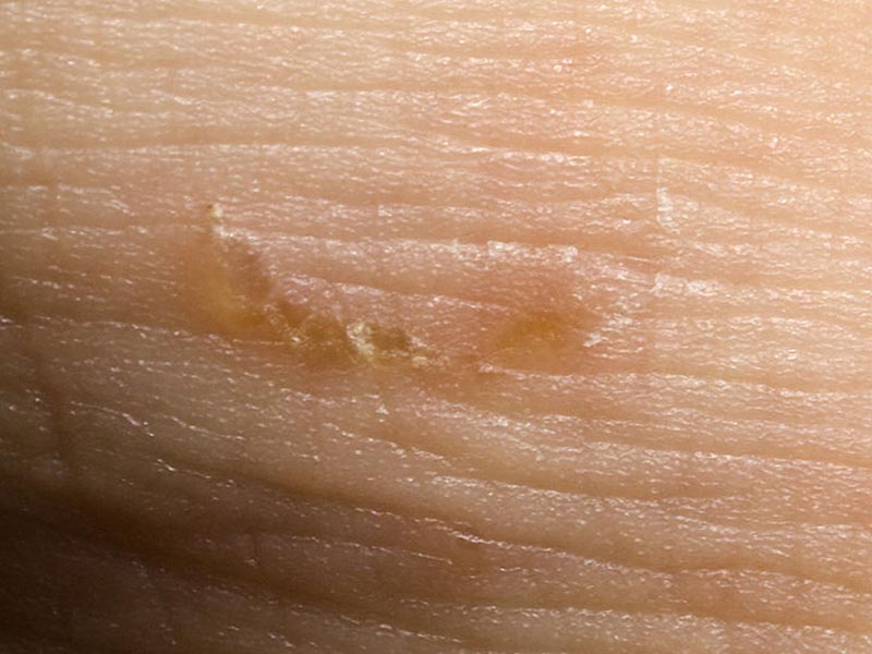 scabies wound