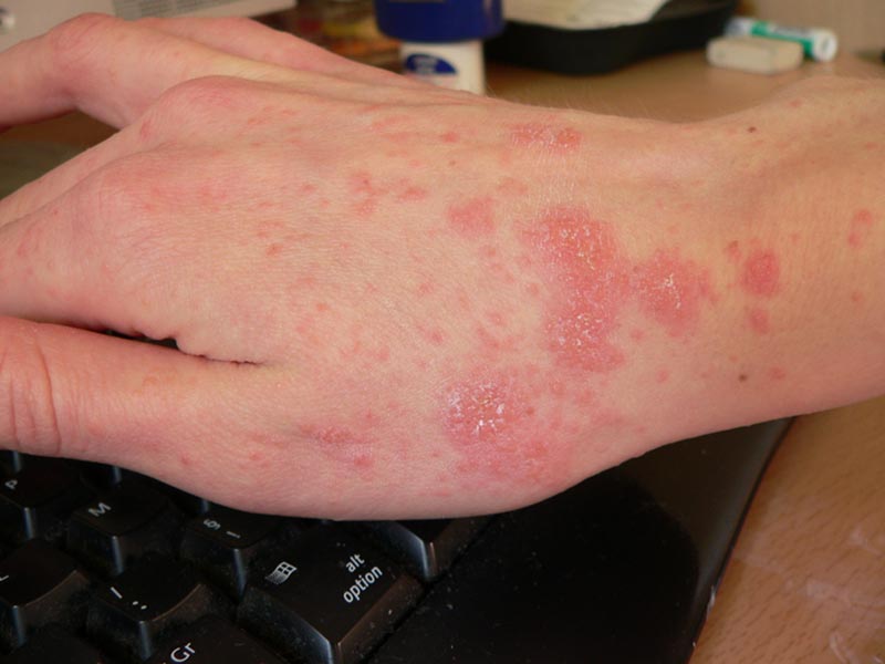 scabies on hand