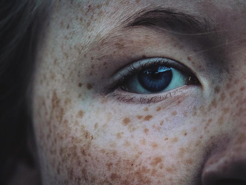 freckled lady