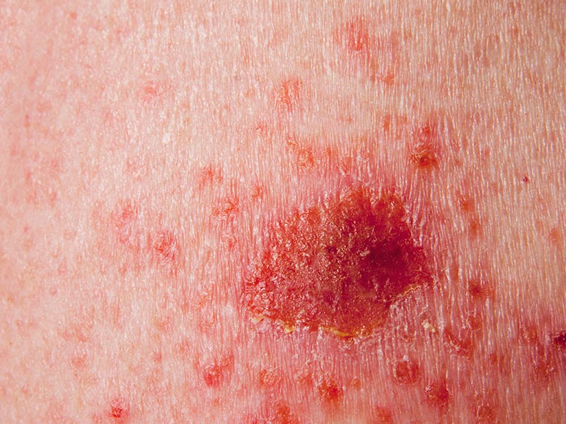 Basal Cell Carcinoma