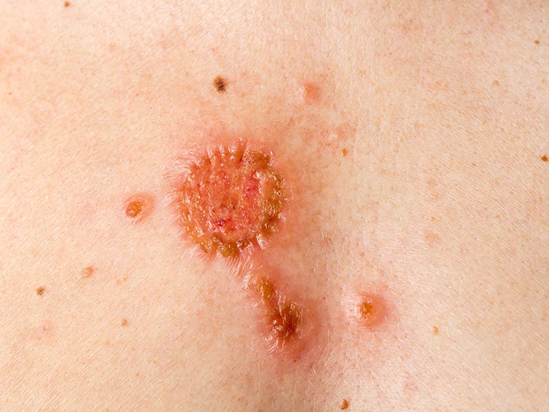 squamous cell carcinoma example