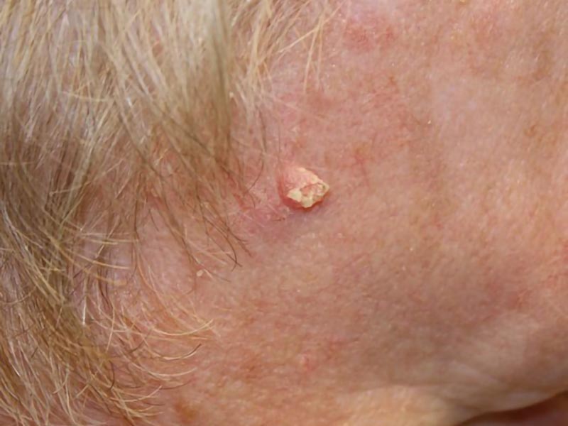 Squamous cell carcinoma near hairline