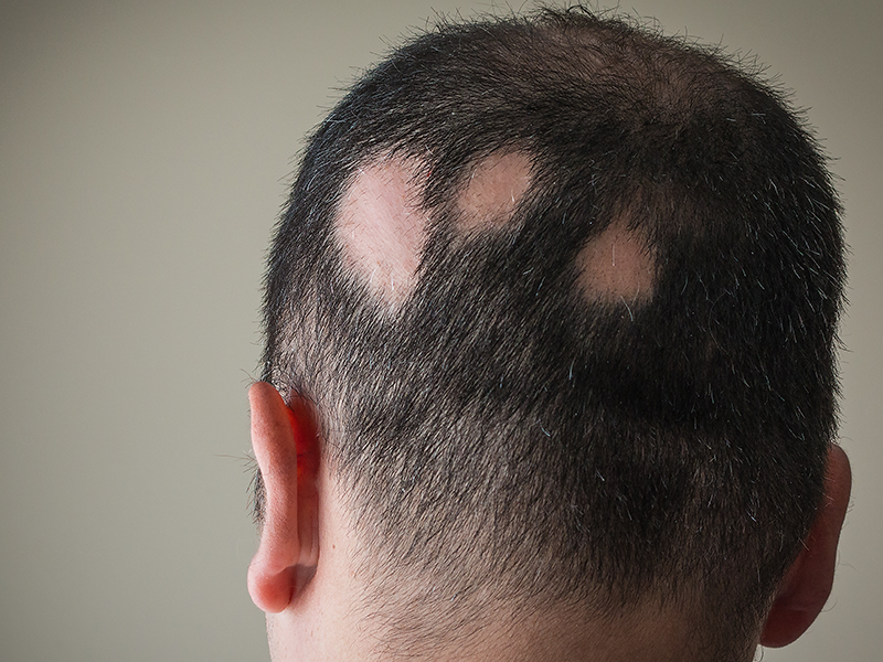 missing patches of hair on man's head