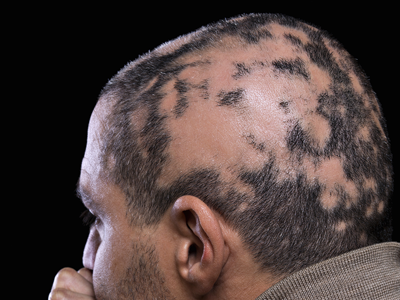 alopecia example