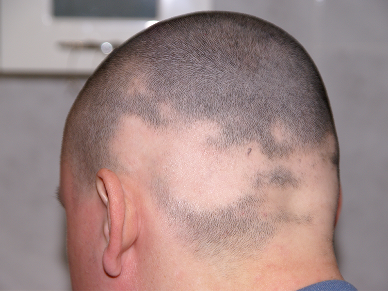 alopecia on man's head