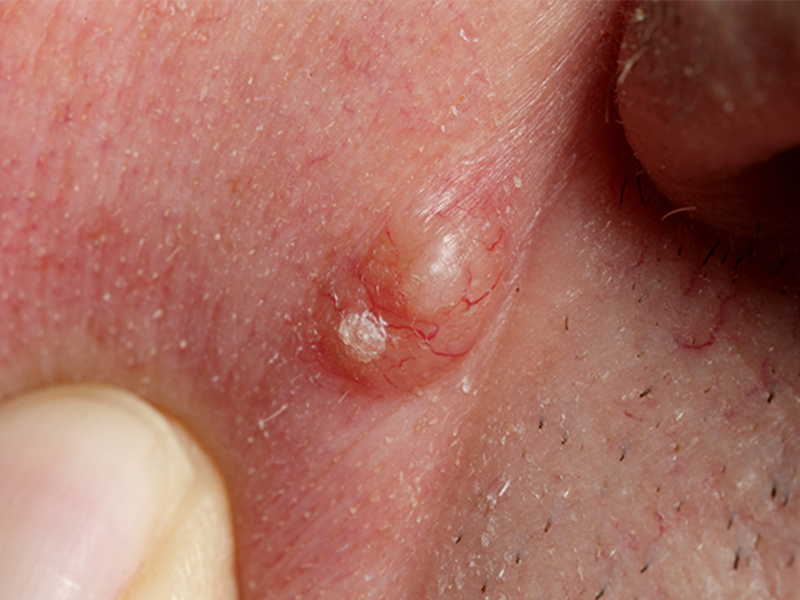 large basal cell carcinoma example