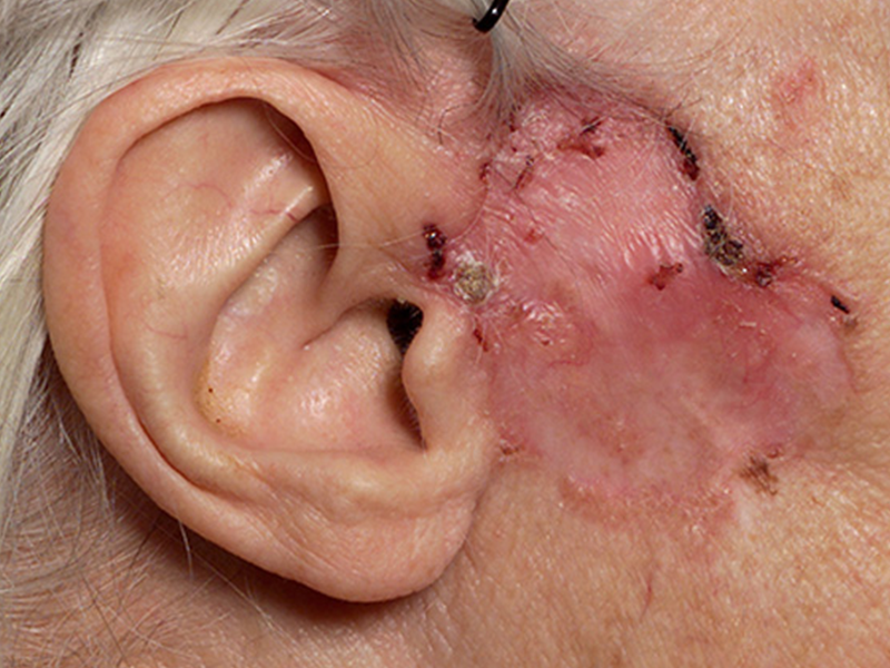 basal cell carcinoma in front of ear