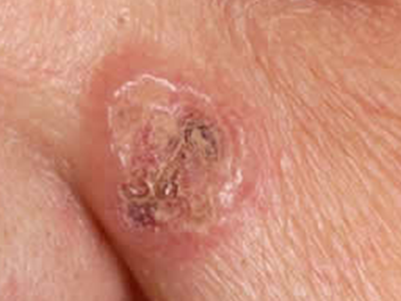 basal cell carcinoma example photo