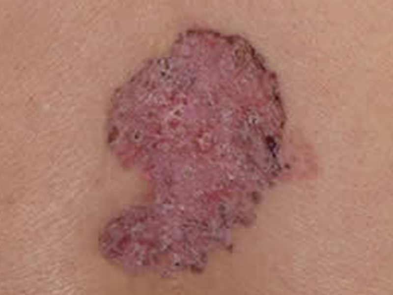 Basal cell carcinoma patch