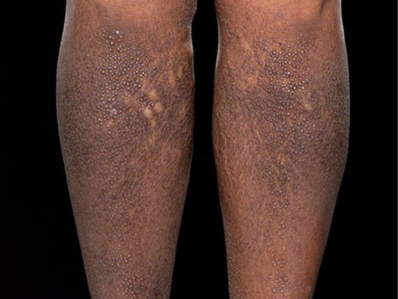 Eczema on legs