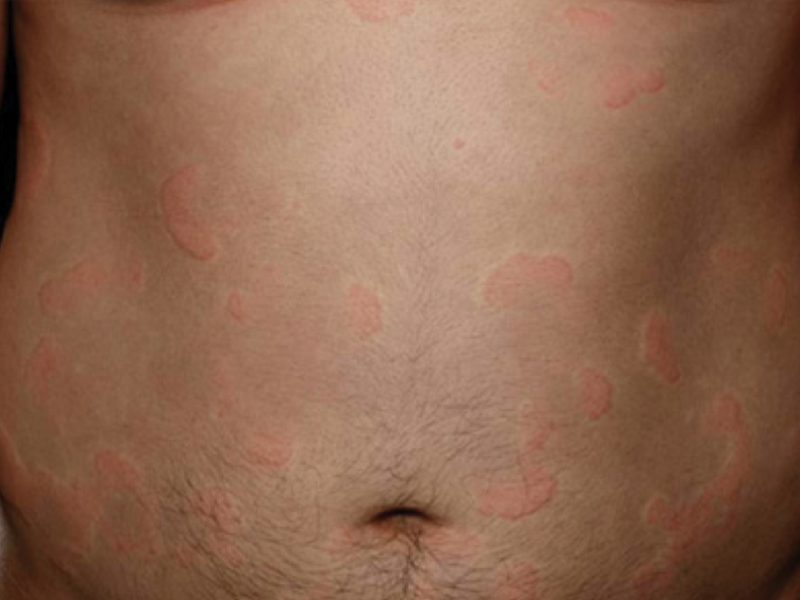 photograph of hives on stomach