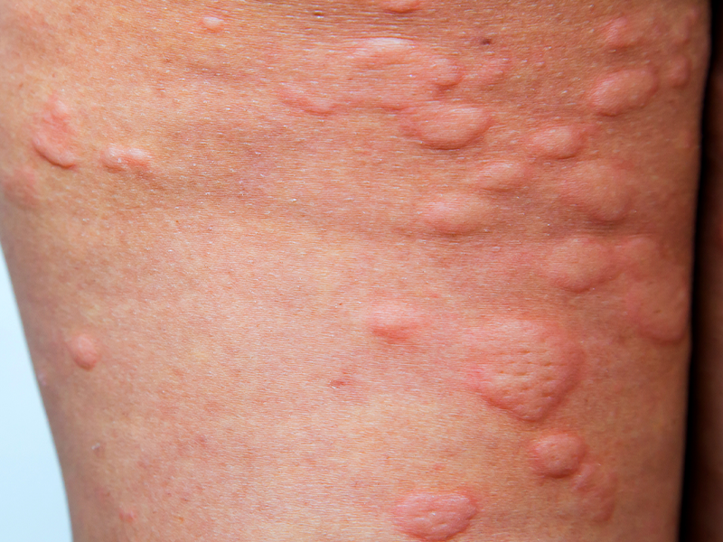 hives bumps