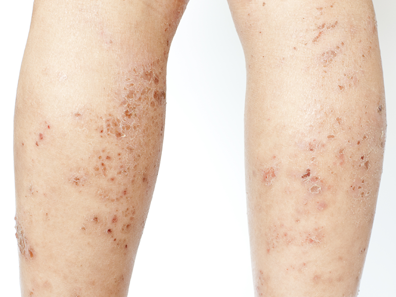 Lichen Planus on legs