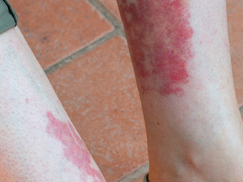 Lichen Planus on leg