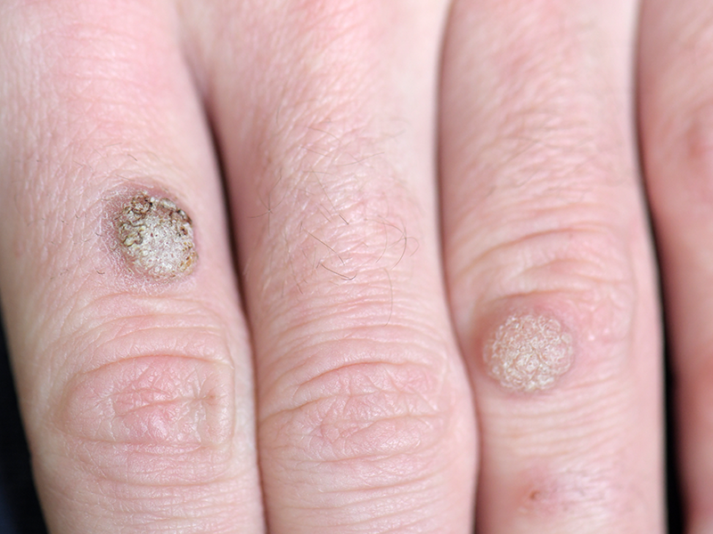 Warts on fingers