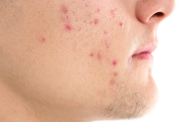 acne scar treatment for your face | Harley Street Dermatology Clinic