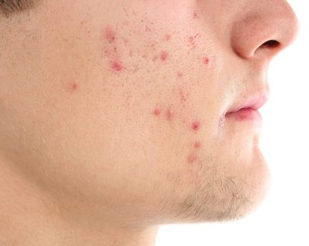 acne scar treatment for your face | Harley Street Dermatology Clinic