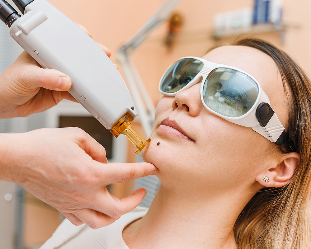 patient undergoing mole removal on her face