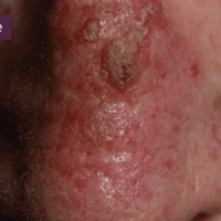 Actinic Keratoses a Male Nose | Harley Street Dermatology Clinic