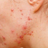 Image of teenager with acne on the face and neck | Harley Street Dermatology Clinic