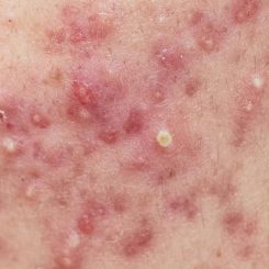 Large fungal acne on skin | Acne treatments in London | Harley Street Dermatology Clinic