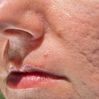 Image of Ice Pick Acne Scarring on Face | Harley Street Dermatology Clinic