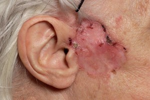 Basal Cell Carcinoma | Dermatologists in London | Harley Street Dermatology Clinic