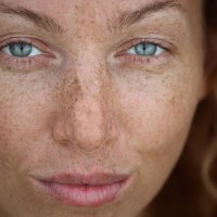 Freckles on a woman's face | Harley Street Dermatology Clinic