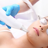 Laser Acne Treatment on the Face | Harley Street Dermatology Clinic