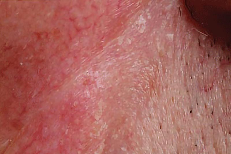 Squamos Cell Carcinoma on skin | Harley Street Dermatology Clinic