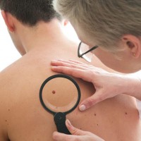 checking moles with a magnifying glass