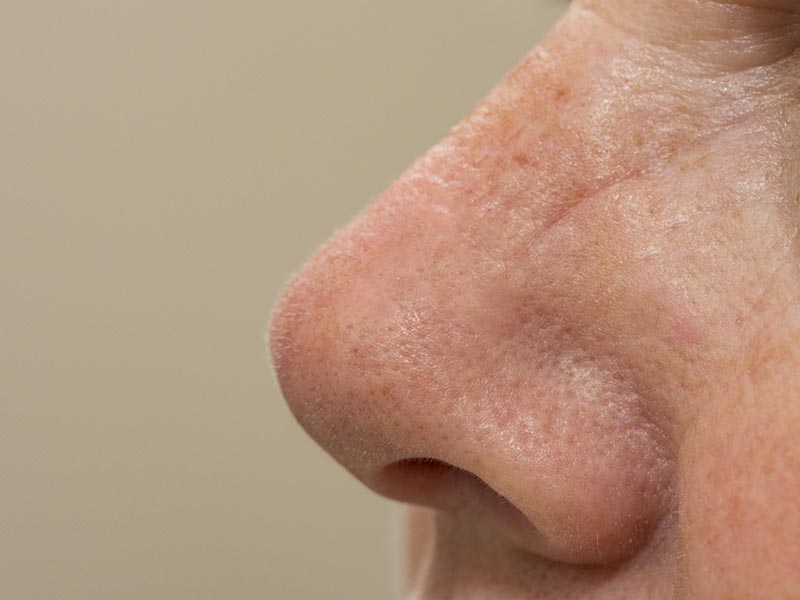 Actinic Keratoses on the Nose | Harley Street Dermatology Clinic