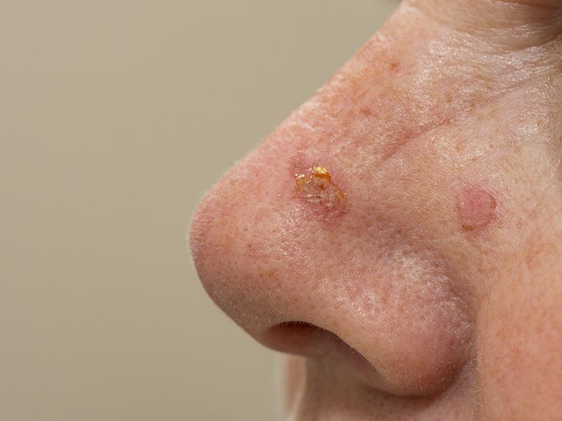 Acne Keratosis on Nose | Acne Keratosis Treatments in London