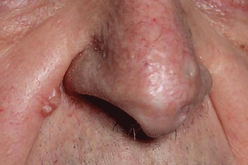 Basal Carcinoma on the Nose | Harley Street Dermatology Clinic