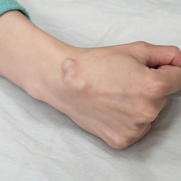 Cyst on clenched fist | Harley Street Dermatology Clinic