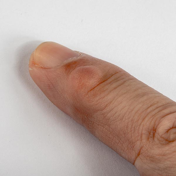 Cyst on forefinger | Harley Street Dermatology Clinic