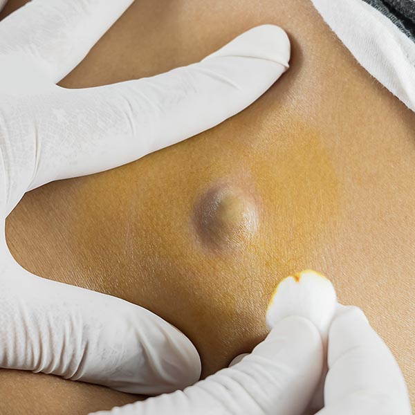 Cyst on the skin | Harley Street Dermatology Clinic